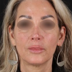 Laser Before & After Patient #3003