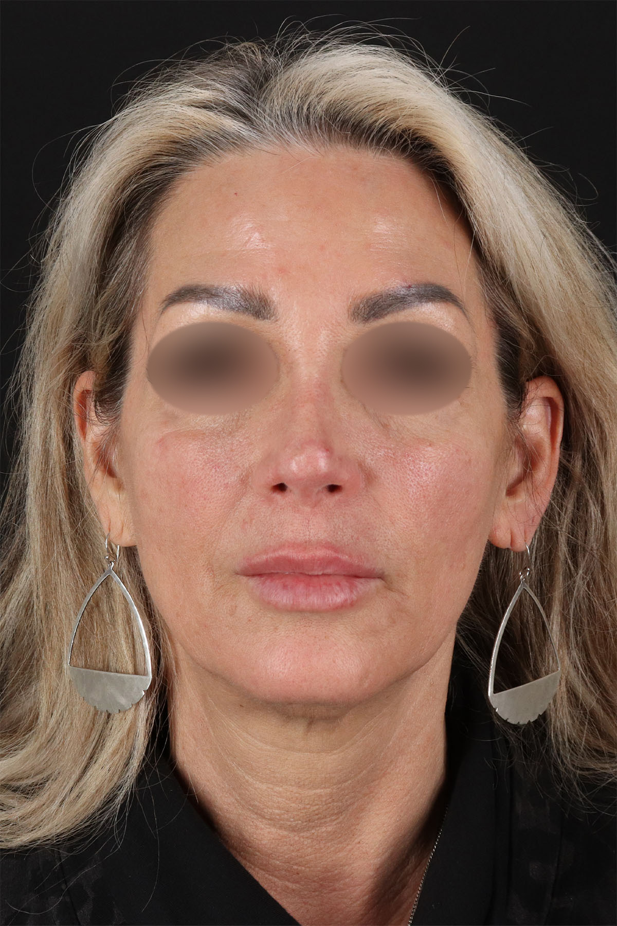 Laser Before & After Patient #3003