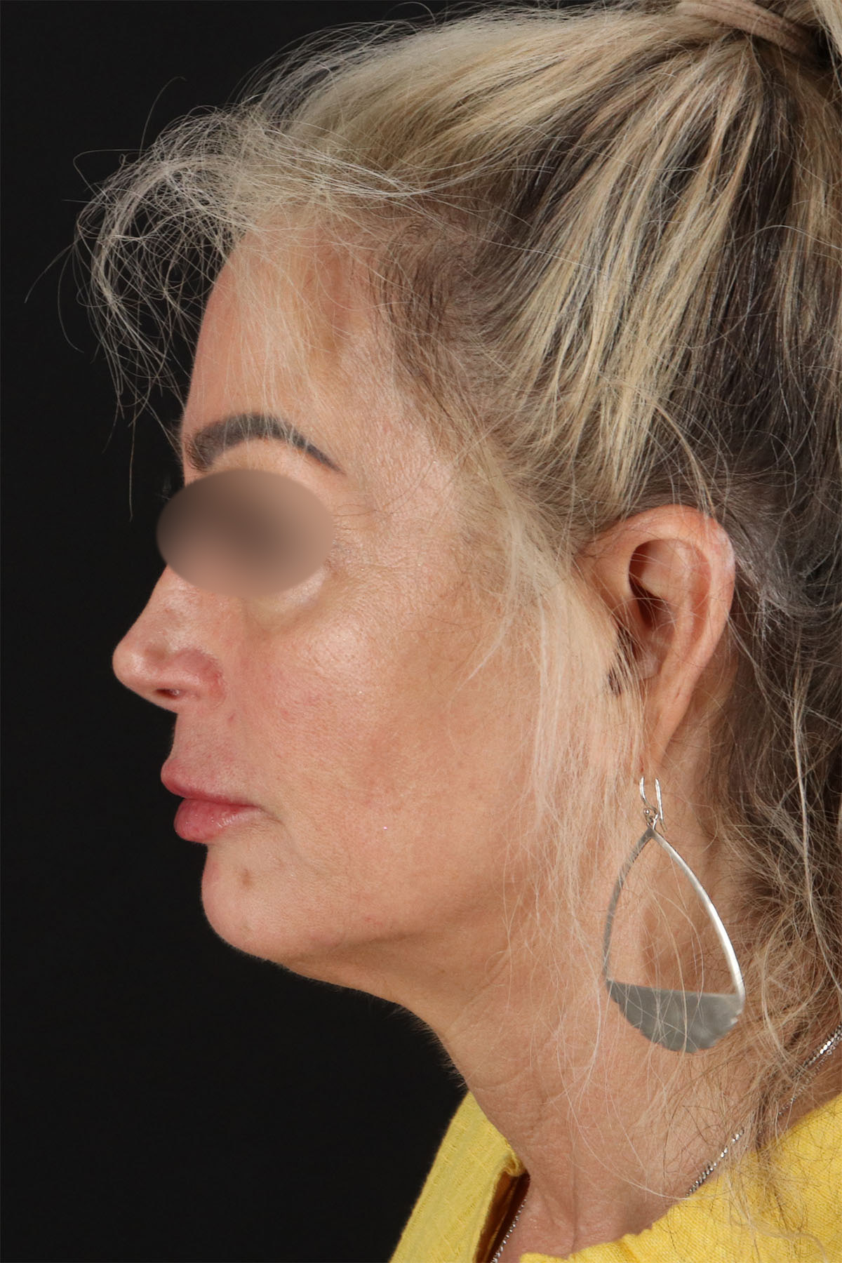 Laser Before & After Patient #3003