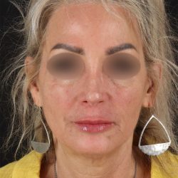 Laser Before & After Patient #3003