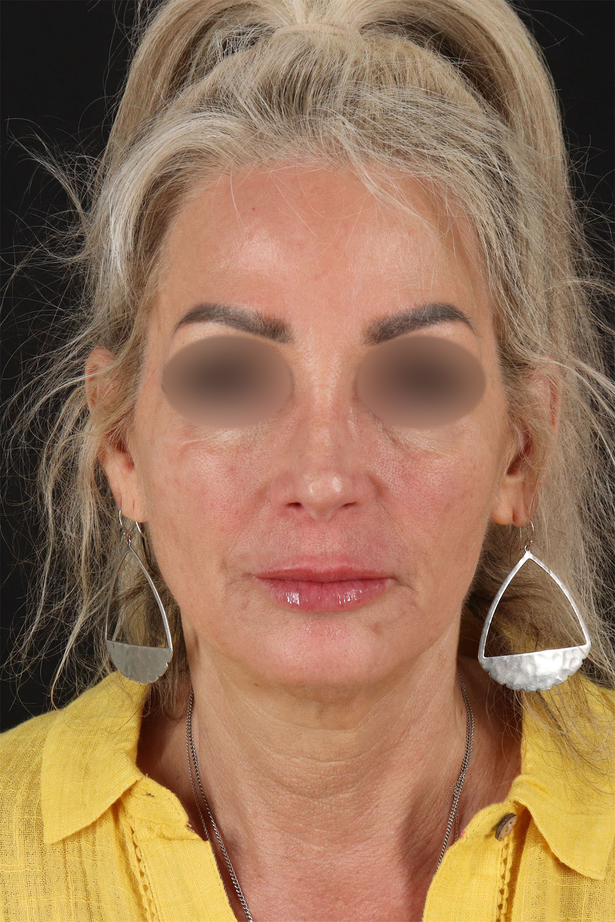 Laser Before & After Patient #3003