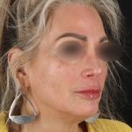 Laser Before & After Patient #3003