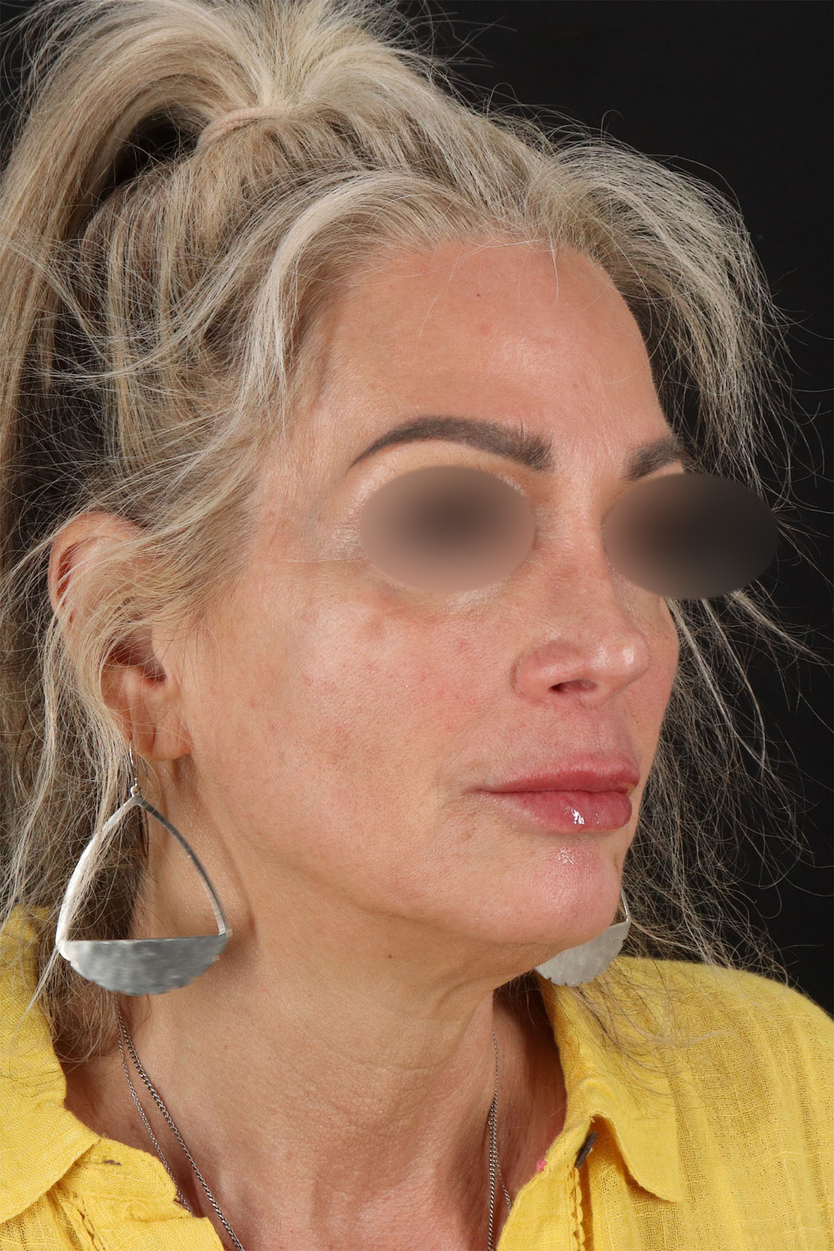 Laser Before & After Patient #3003