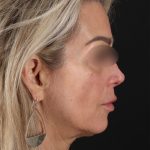 Laser Before & After Patient #3003