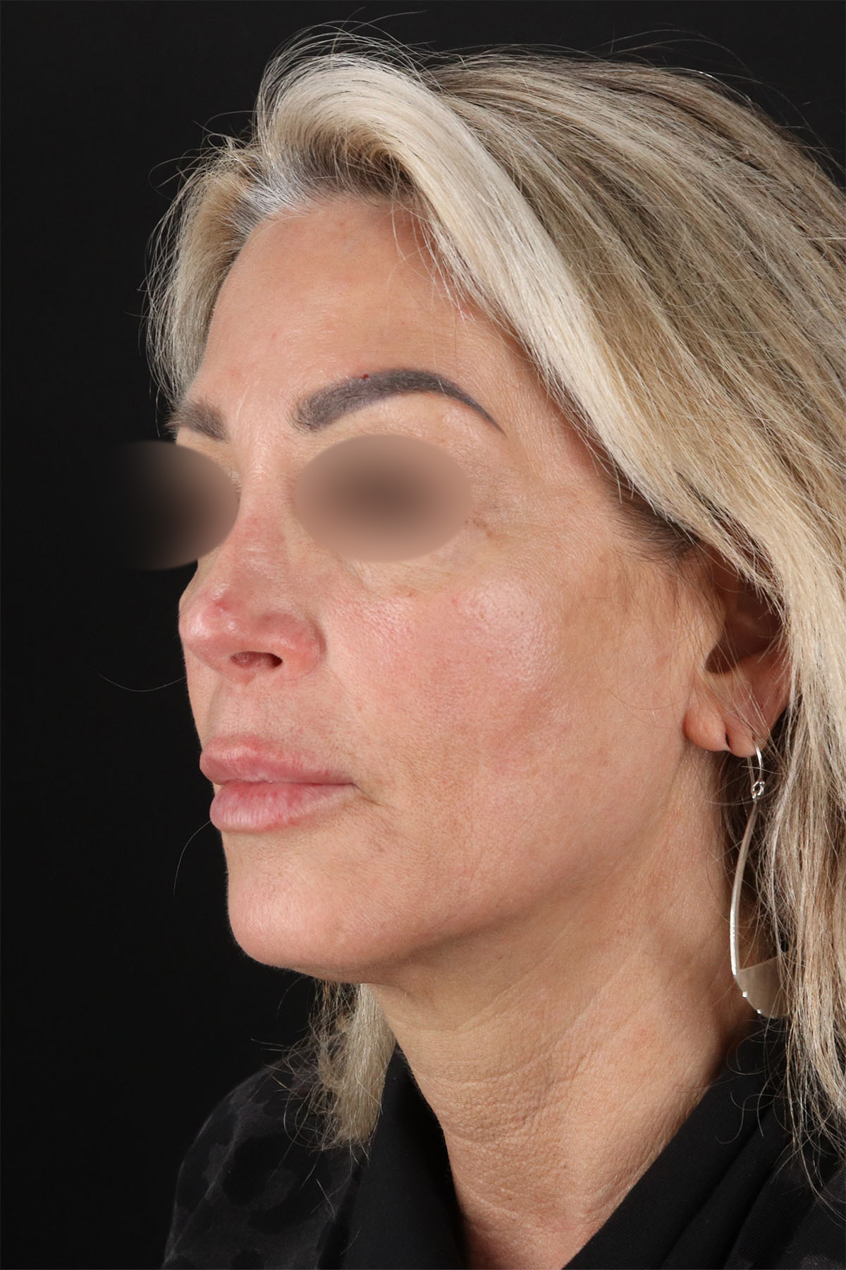 Laser Before & After Patient #3003