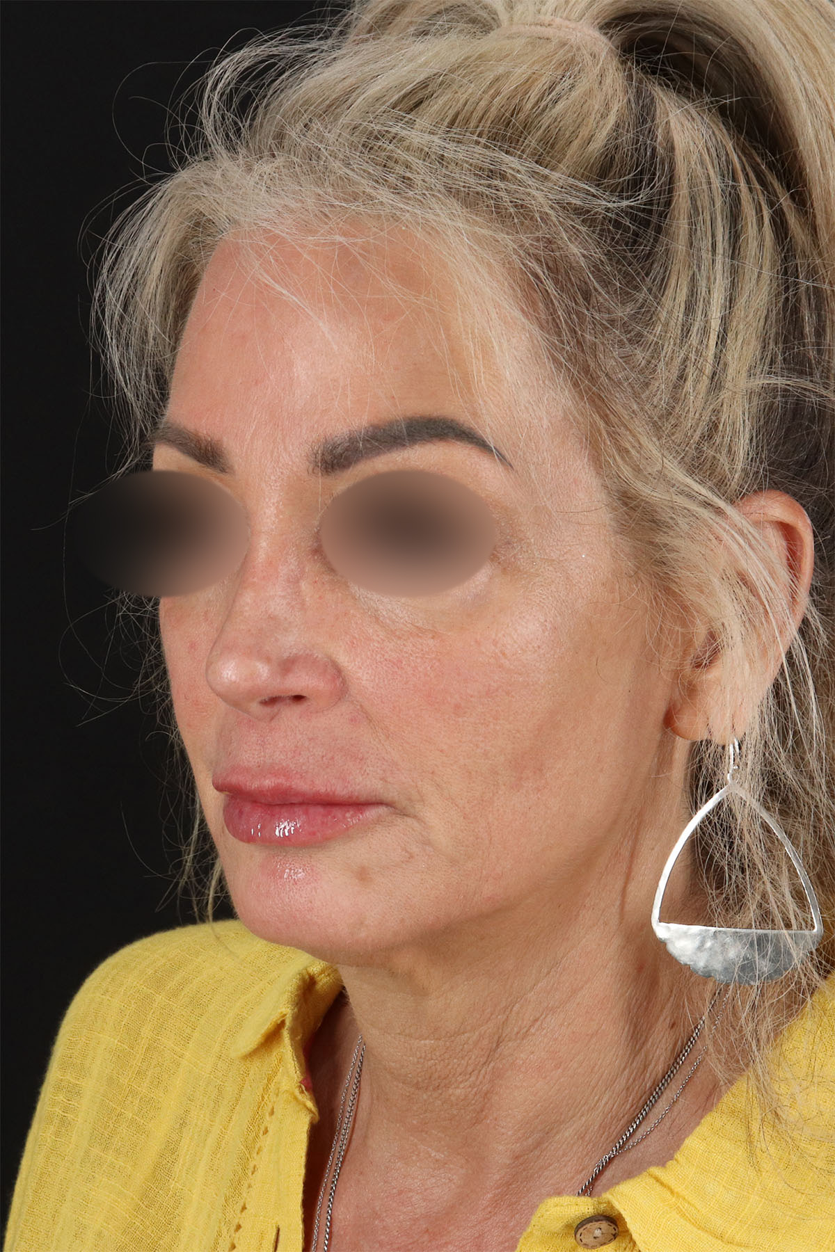 Laser Before & After Patient #3003