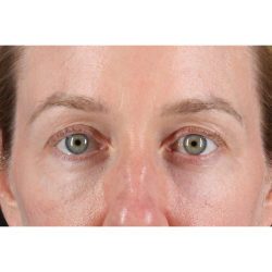 Eyelid Surgery Before & After Patient #3800