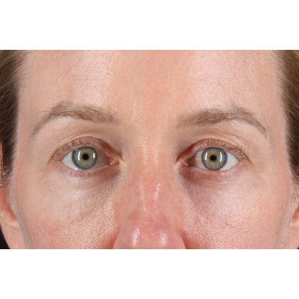Eyelid Surgery Before & After Patient #3800