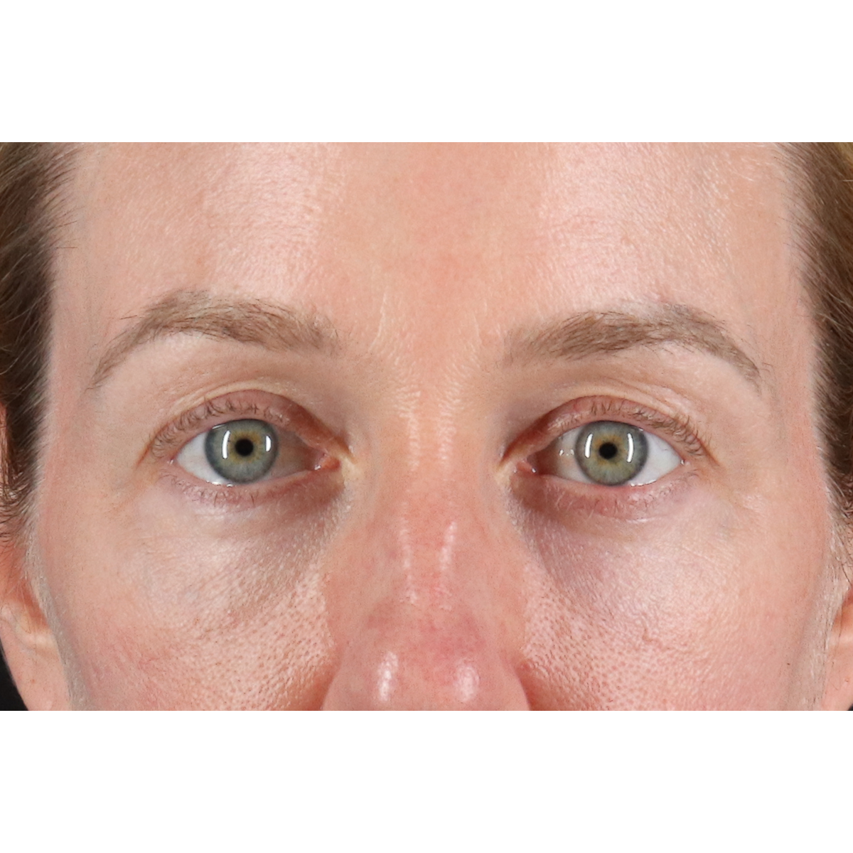 Eyelid Surgery Before & After Patient #3800