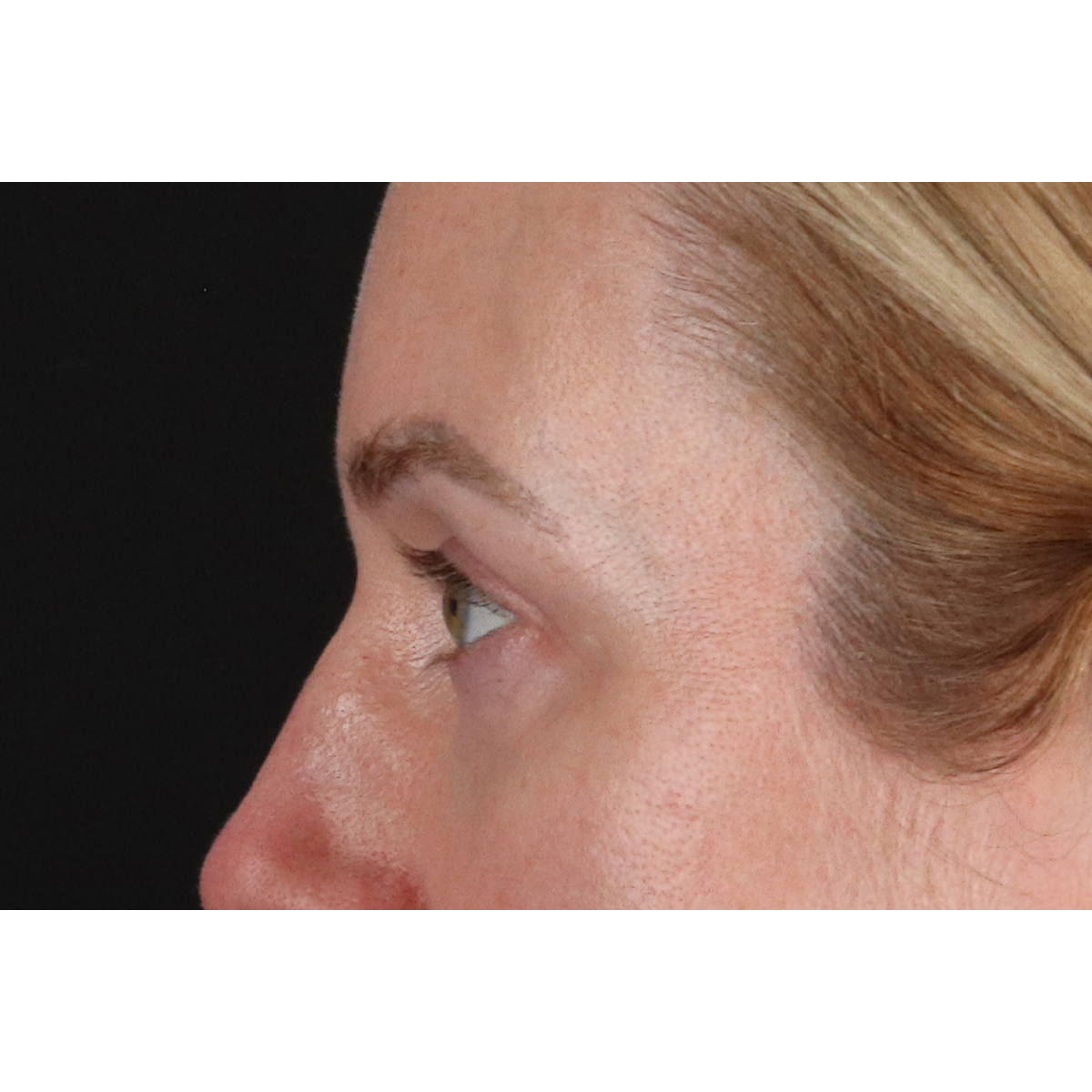 Eyelid Surgery Before & After Patient #3800
