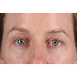 Eyelid Surgery Before & After Patient #3800