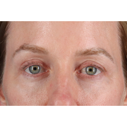 Eyelid Surgery Before & After Patient #3800