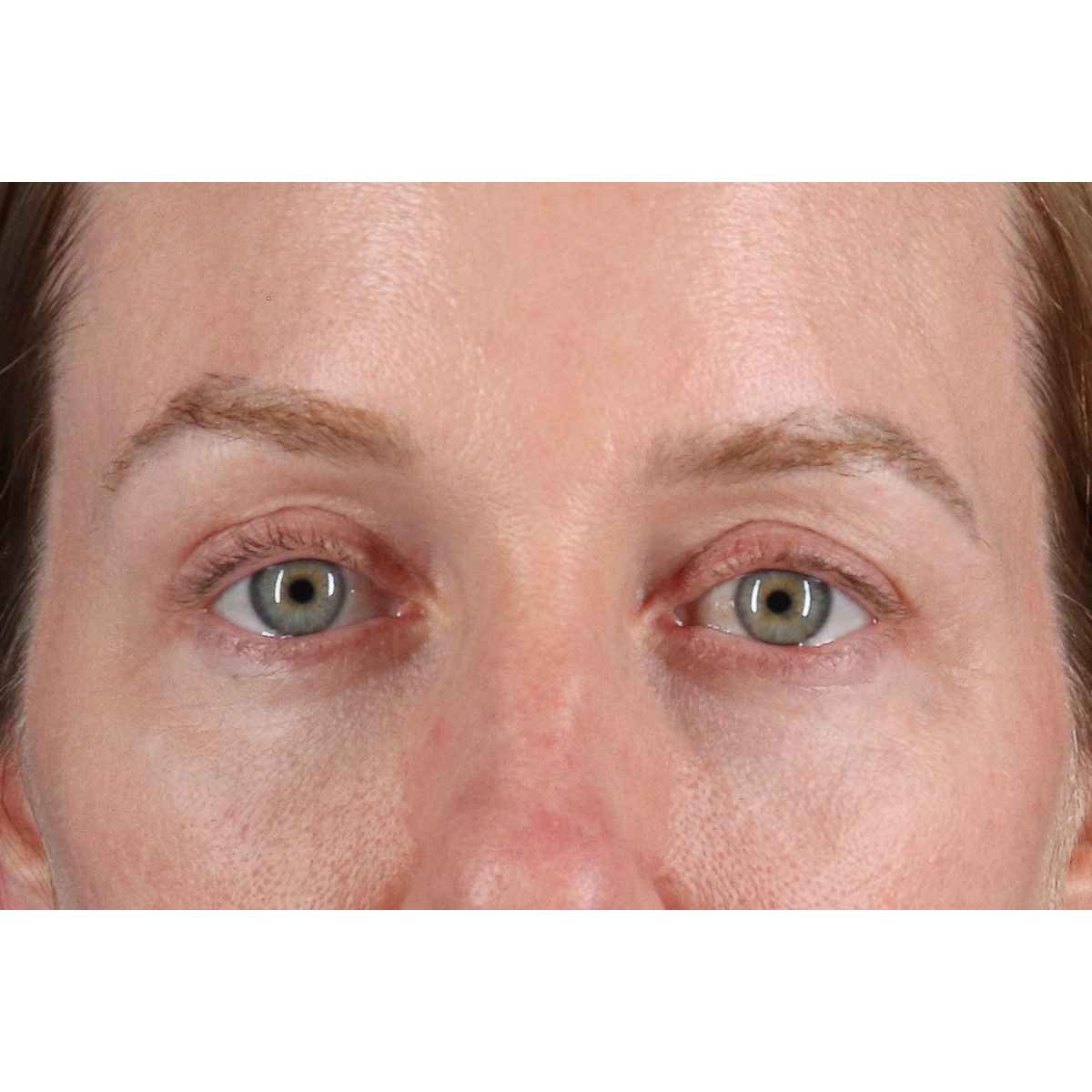 Eyelid Surgery Before & After Patient #3800