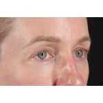 Eyelid Surgery Before & After Patient #3800