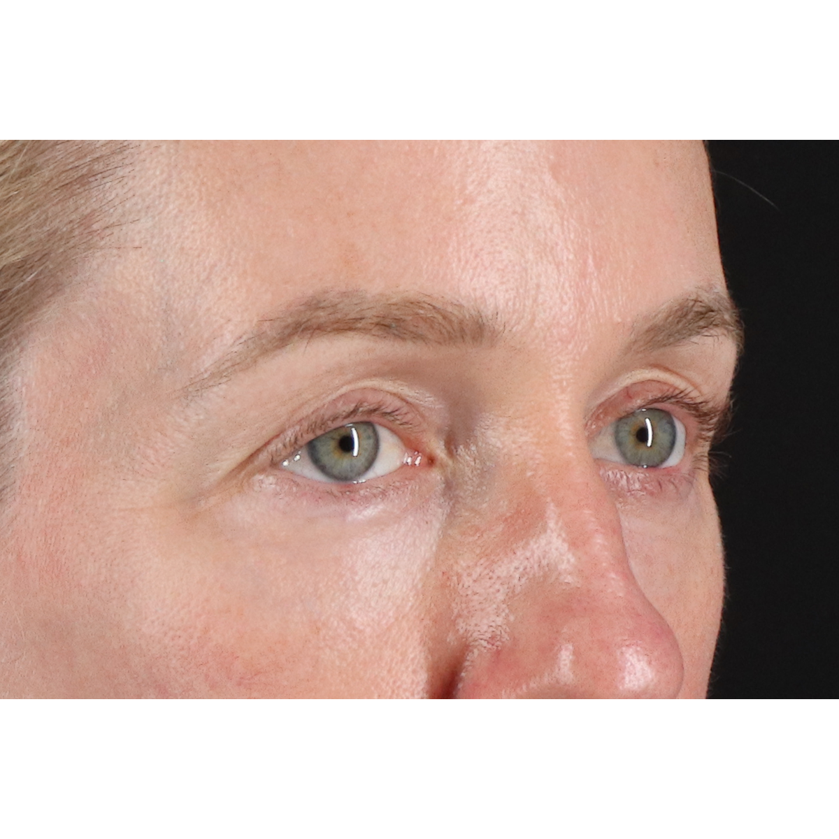 Eyelid Surgery Before & After Patient #3800