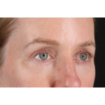 Eyelid Surgery Before & After Patient #3800