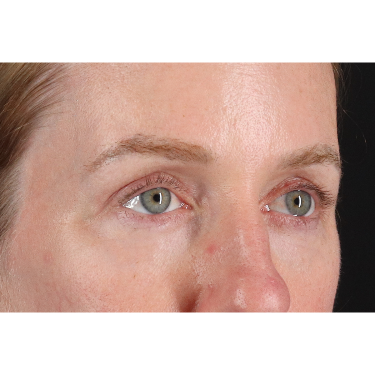 Eyelid Surgery Before & After Patient #3800
