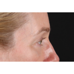 Eyelid Surgery Before & After Patient #3800