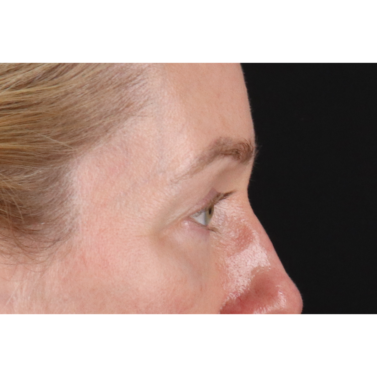 Eyelid Surgery Before & After Patient #3800