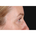 Eyelid Surgery Before & After Patient #3800