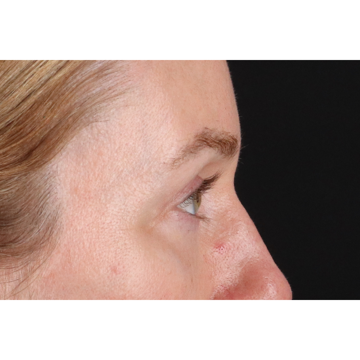 Eyelid Surgery Before & After Patient #3800