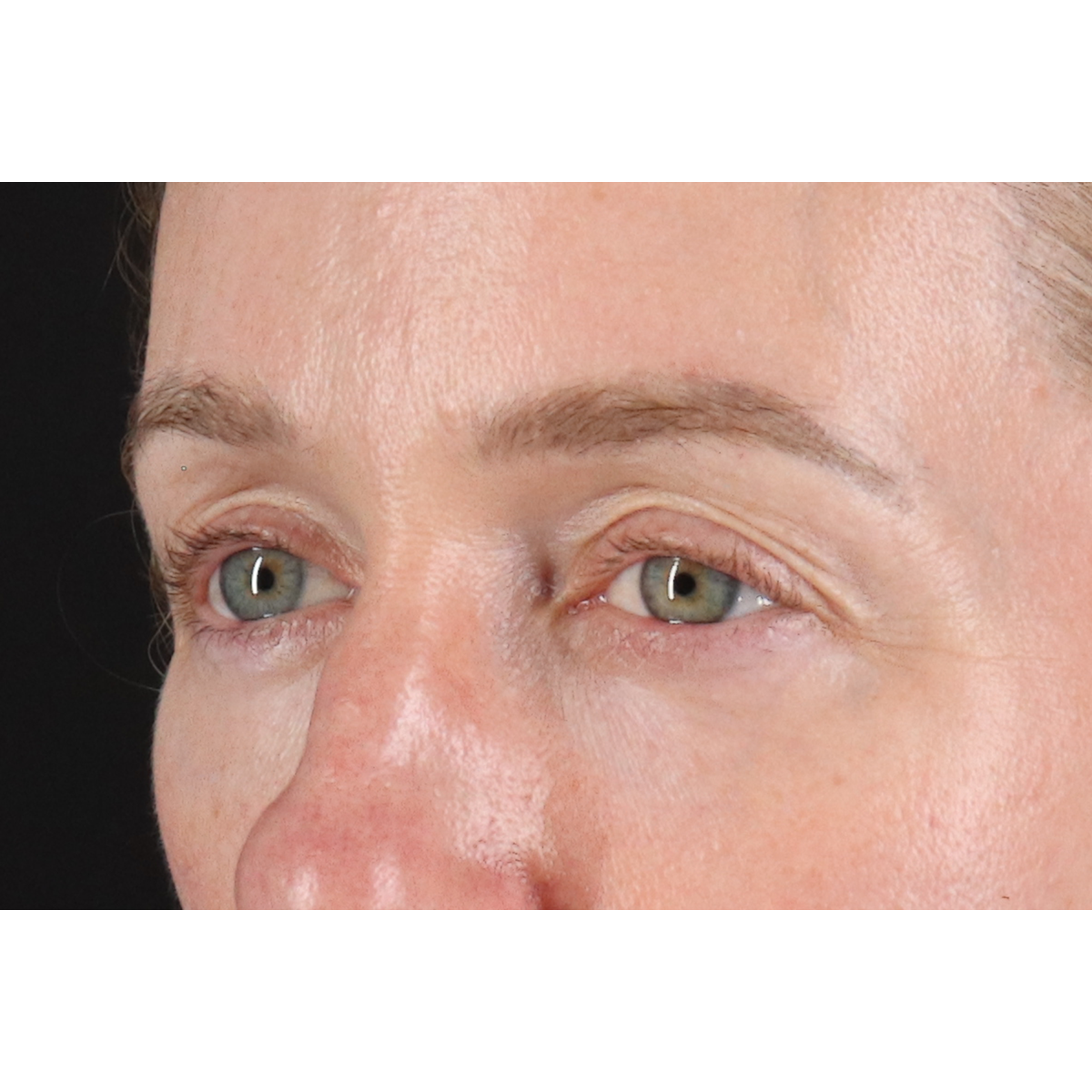 Eyelid Surgery Before & After Patient #3800