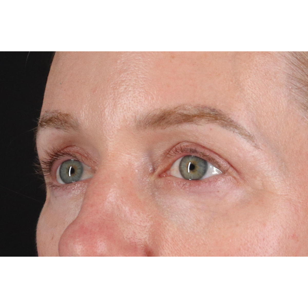 Eyelid Surgery Before & After Patient #3800