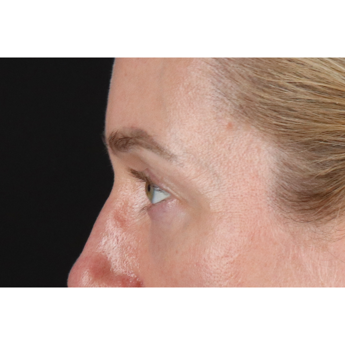 Eyelid Surgery Before & After Patient #3800