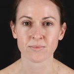 Structural Fat Grafting Before & After Patient #3929