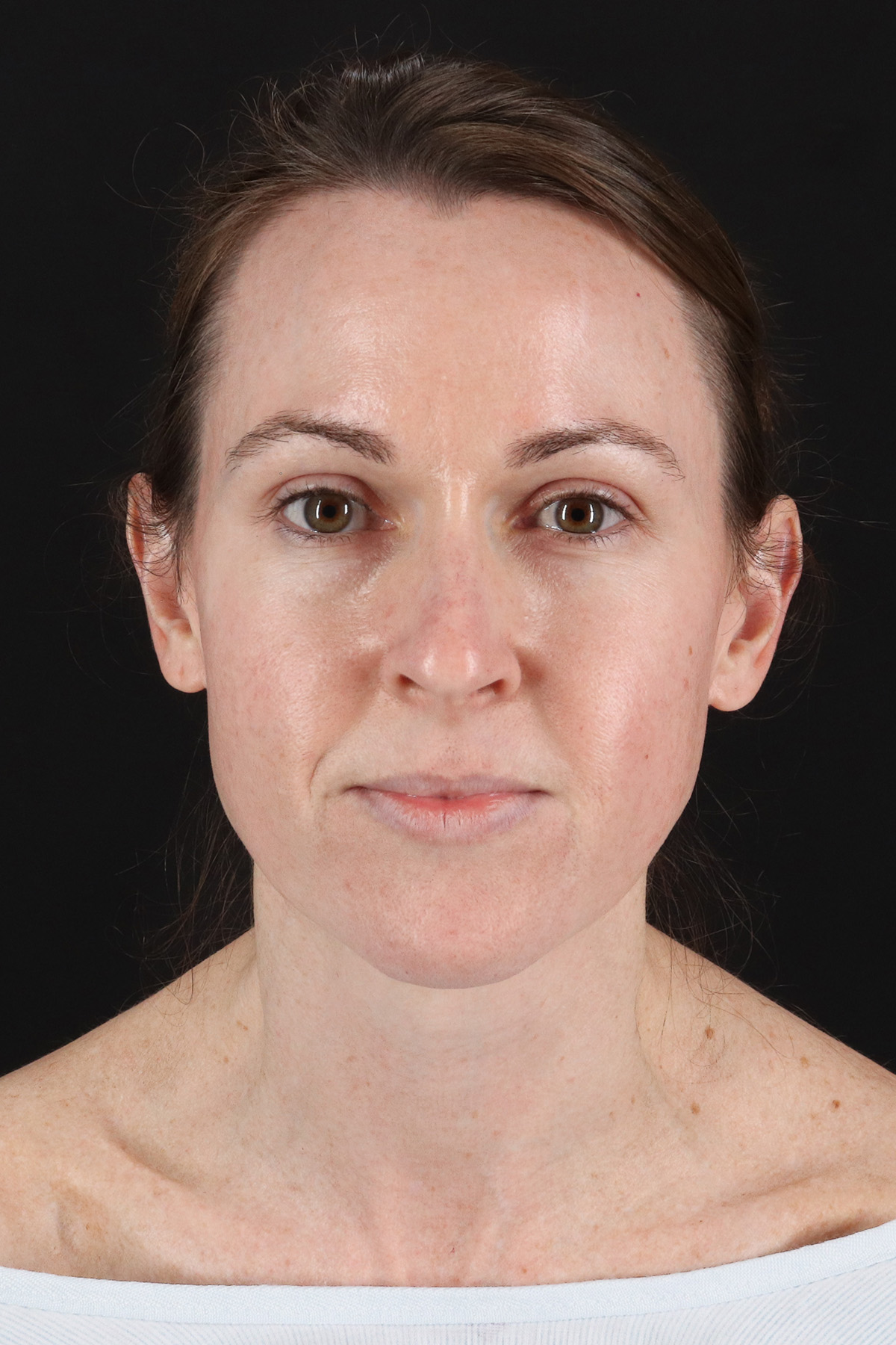 Structural Fat Grafting Before & After Patient #3929