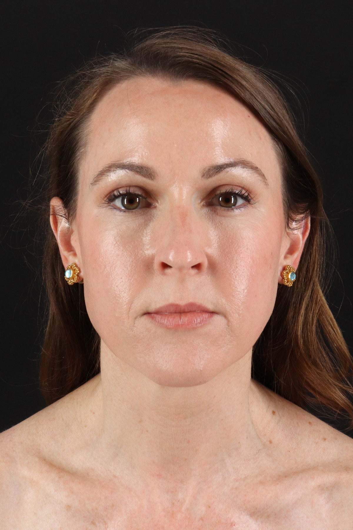 Structural Fat Grafting Before & After Patient #3929
