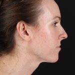 Structural Fat Grafting Before & After Patient #3929