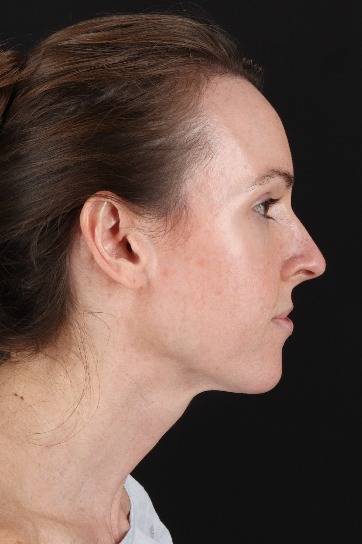 Structural Fat Grafting Before & After Patient #3929