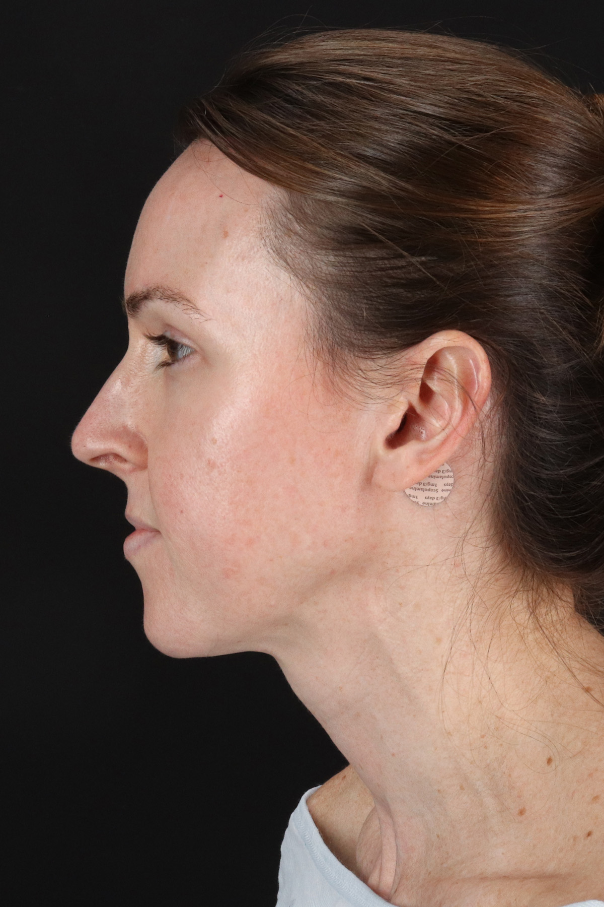 Structural Fat Grafting Before & After Patient #3929
